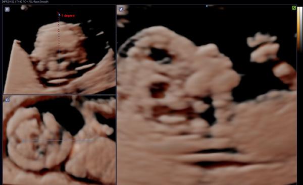 generates nine standard fetal echocardiography views simultaneously in a single template.