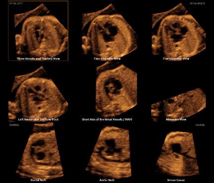 Evaluation of fetal condition becomes more efficient as 5D LB improves measurement accuracy while reducing exam time.