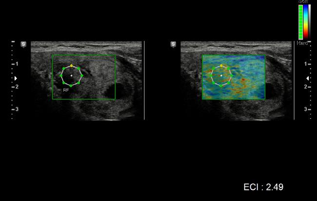 EFFICIENCY IN DIAGNOSIS FOR HIGHER PATIENT THROUGHPUT E-Breast (ElastoScan for Breast) E-Breast technology calculates the strain ratio between the