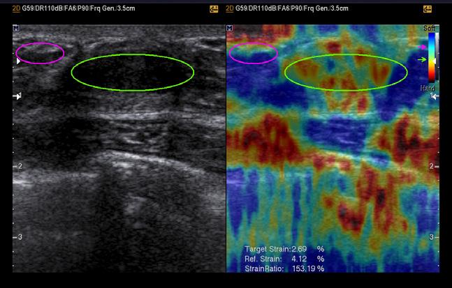 Breast elastography with strain index E-Thyroid (ElastoScan for Thyroid) E-Thyroid technology provides more objective assessment of thyroid lesions by