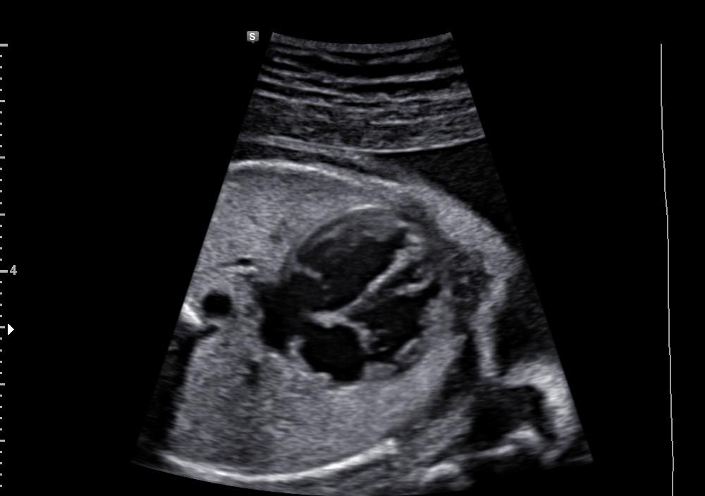 Umbilical cord with S-Flow