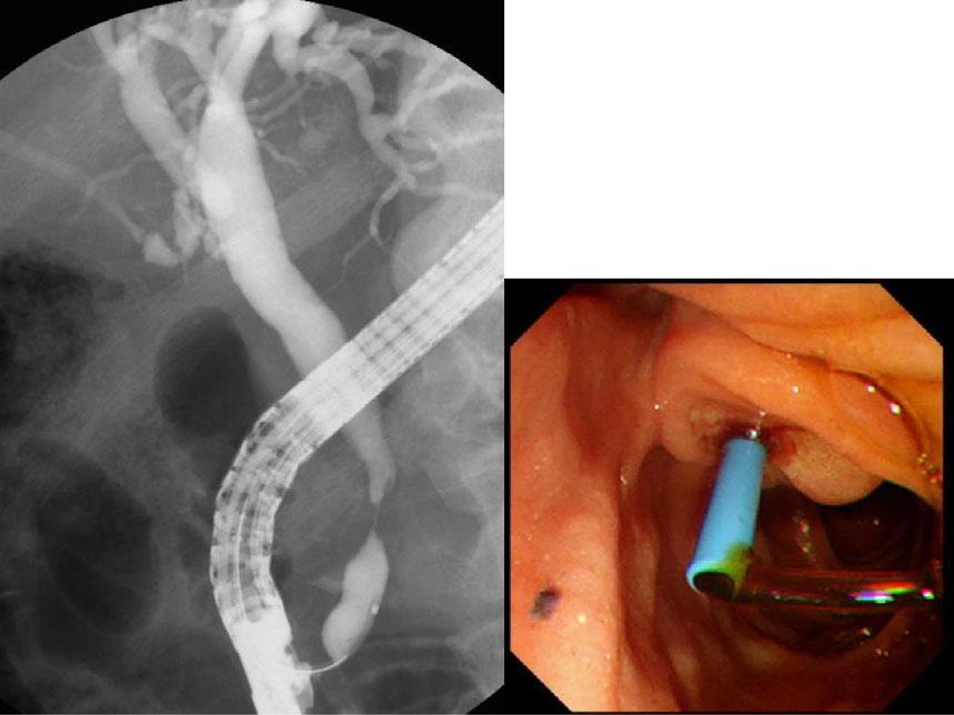 Digestive Endoscopy 2017; 29: (Suppl. 2): 88 93 Management of occluded biliary stent 89 Management of cholangitis and the SEMS are the two main considerations in these cases.