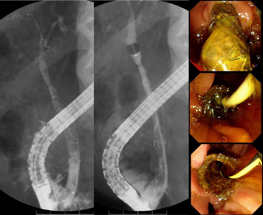 Digestive Endoscopy 2017; 29: (Suppl. 2): 88 93 Management of occluded biliary stent 91 (a) (b) (c) (d) (e) Figure 4 Removal of sludge with a balloon catheter.
