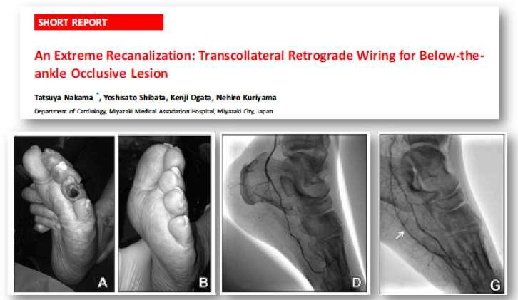 Experience of Pedal revascularization
