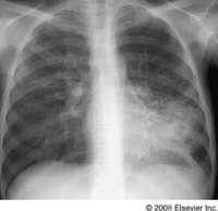NTM and Chronic Lung Disease Environmental