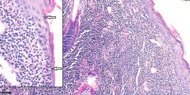 Figure 1 A diffuse infiltrate of small, monomorphic lymphocytes occupies the entire dermis. Hematoxylin and eosin stain, x 20.
