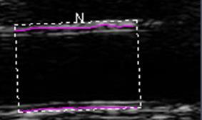 Flow-mediated dilatation (%) Endothelial