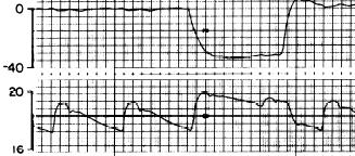 Intrathoracic pressure swings Intrathoracic pressure change increases aortic diameter 0 Intrathoracic pressure (mmhg)
