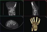 Within orthopedic 3D imaging Planmed offers low dose extremity CT imaging for quicker, easier and more accurate diagnosis at the Point-of-Care.