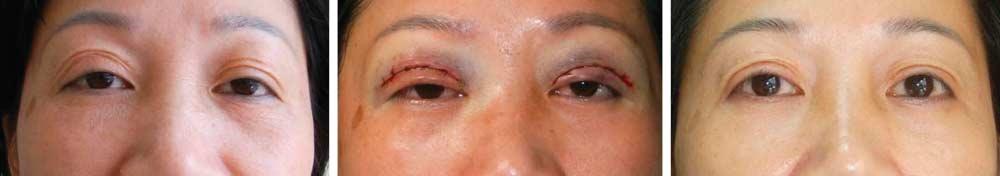 C Figure 4. Unsatisfactory radian of the double eyelid before surgery () and immediately () and 6 months (C) after surgery. Figure 5.