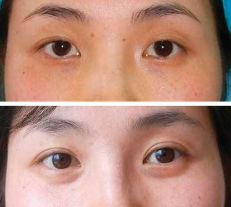 This may cause depression of the upper eyelid, difficulty in lifting the eyelids, and lazy eyes.
