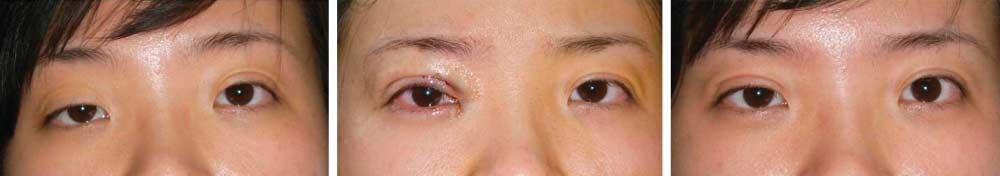 C Figure 6. Upper eyelid weakness before surgery () and immediately () and 6 months (C) after surgery.