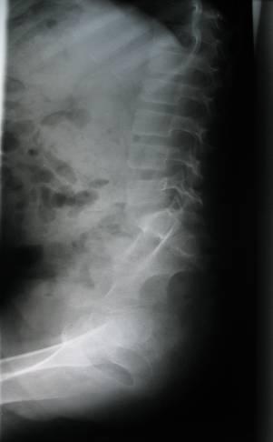 Thoracic spine x-ray x (07.04.