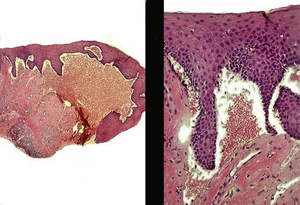 Clinically: Elderly, F>M Severity Two types: Bullous Pemphigoid: Skin 10-20% oral lesions + DIF, + IDIF in 75% of cases