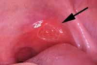 2. Major aphthous ulcer 2 nd most common 1-10 but frequently 1-2 at any one time