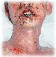 on lips and ant mouth, erythematous vesiculobullous eruptions erosions -
