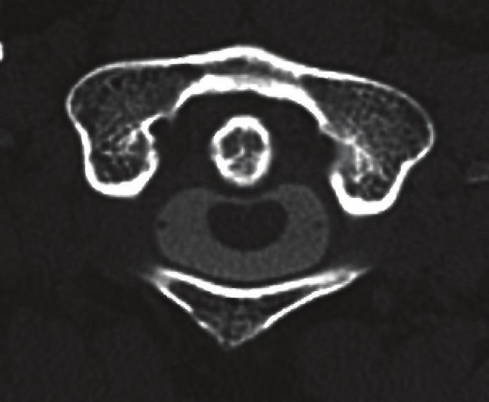 In (a) sagittal and (b) axial T2- weighted images, the high intensity area suggested fluid accumulation between