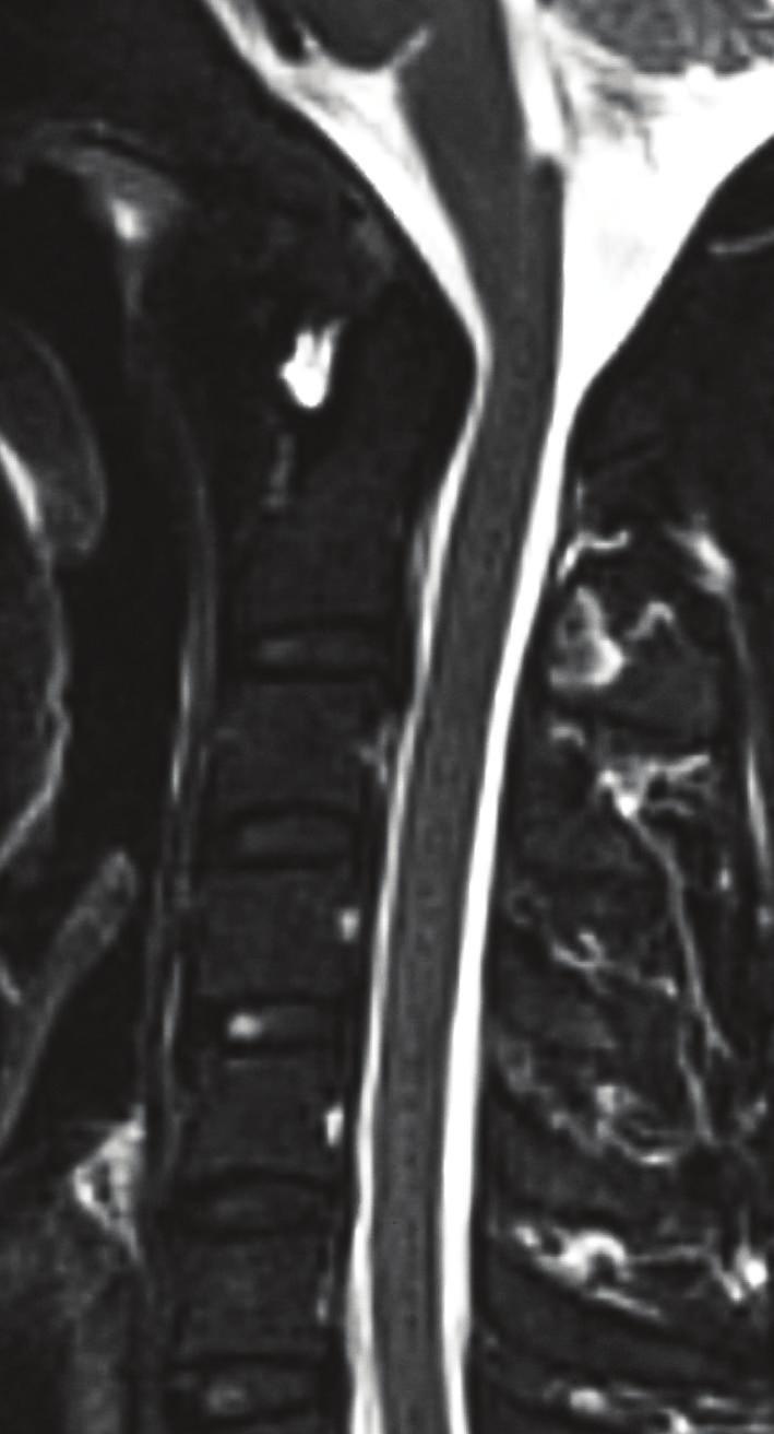 An increased ADI was apparent without evidence of fracture at the attachment site of the transverse ligament.
