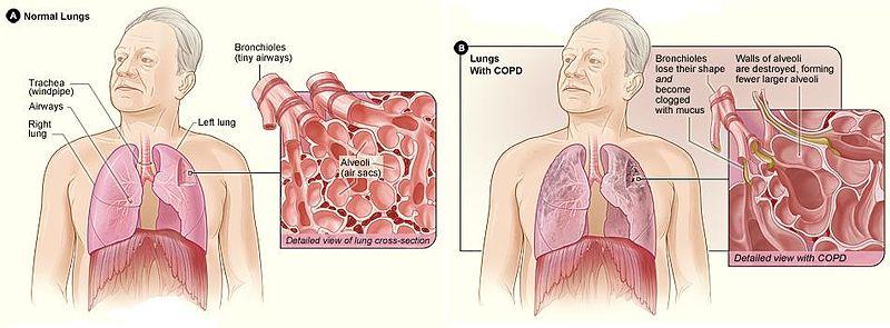 Obstructive Lung Disease: COPD