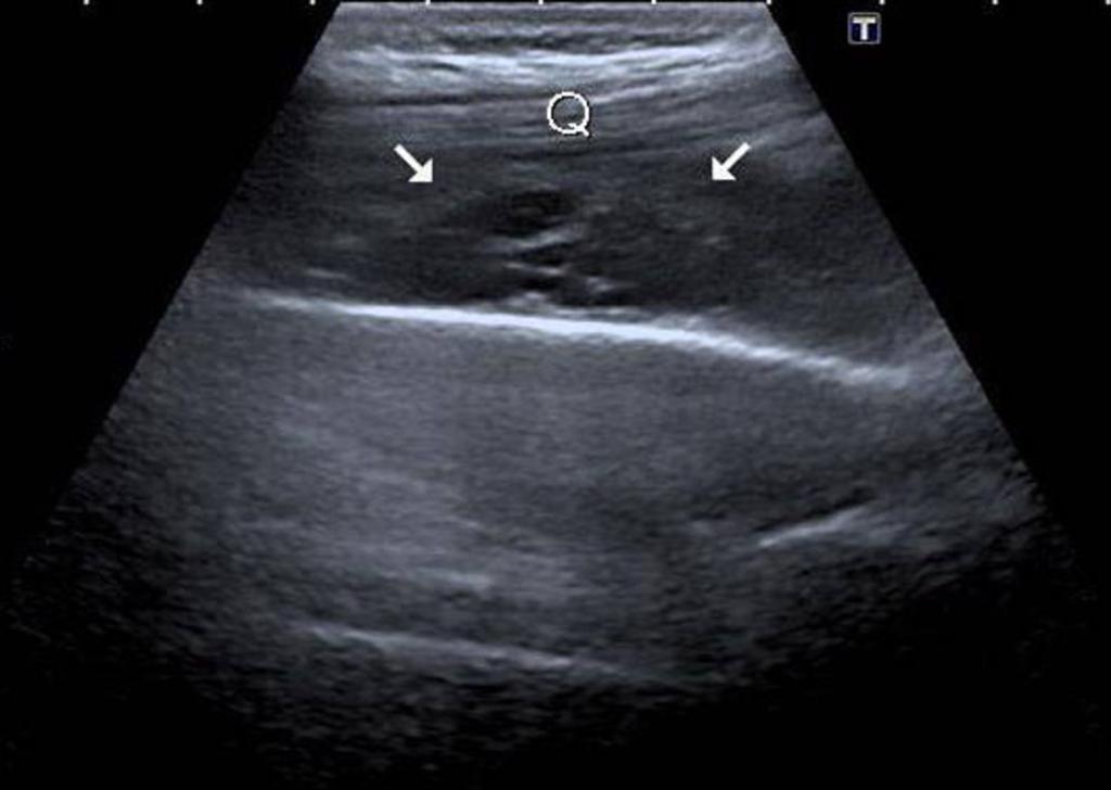 Fig. 1: Hypoechoic soft tissue lesion (arrows) in the