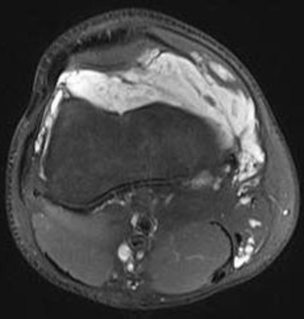 Fig. 3: T2 weighted fat saturated image demonstrates hyperintense tubular lesion