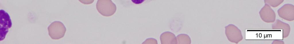 with clefted nuclear margins (arrowhead) and large lymphocyte with a visible nucleolus and