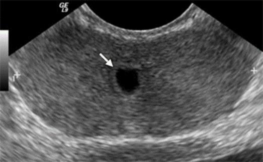 Ultrasonography in male infertility diagnostics Transrectal ultrasonography findings: Dilated seminal vesicles