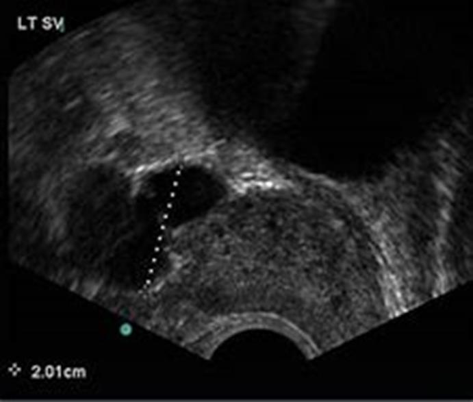 Palpable vasa Normal testicular size with normal T Practice Committee of the American Society for Reproductive