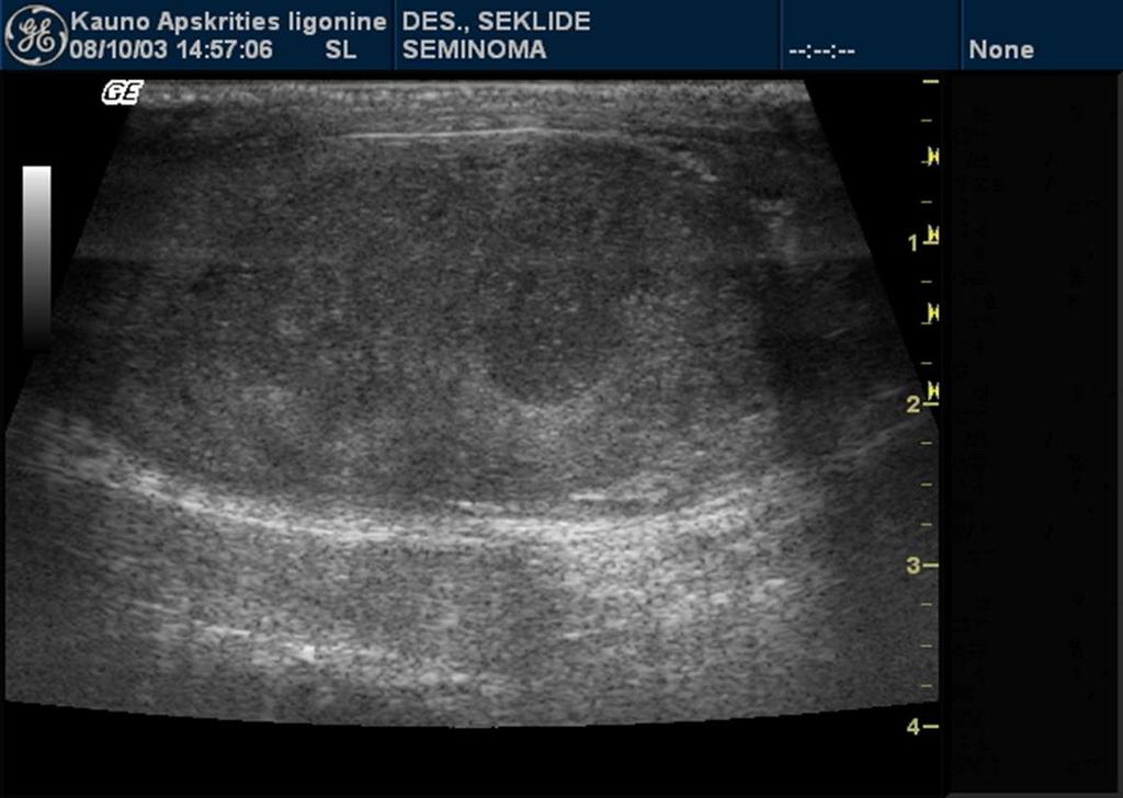 Ultrasonography in male infertility diagnostics (2)