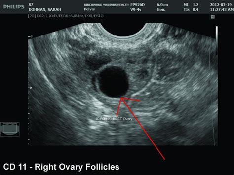 Ovulatory function ASRM, 2015 Transvaginal ultarsonography Anovulatory women
