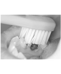 Technique 1 in permanent teeth