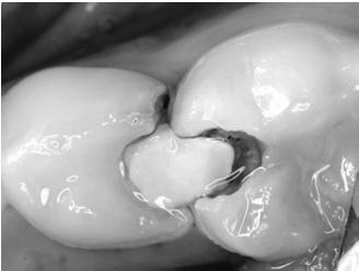 Do you have to remove dental caries? When, why and how much? Why complete caries removal is not necessary What do we mean by caries?