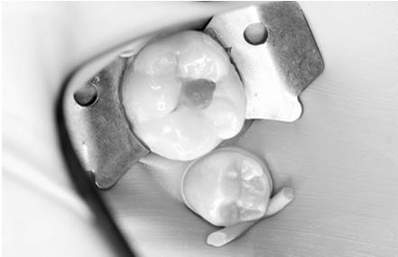 Dental Association recommendations Do you have to remove dental caries? When, why and how much?