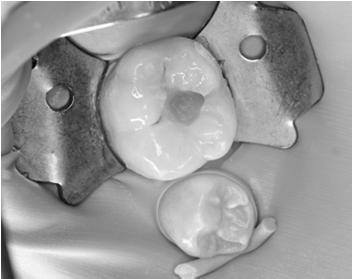Further weakeni ng of tooth Reduces remaining dentine thickness risk of pulp exposure Operative intervention Restoration fails & is made larger Placement of