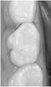 Peters MC, et al. In vivo dentin remineralization by calcium-phosphate cement. J Dent Res 2010 89: 286 291.