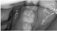 and restore 3 Partial caries removal and restore 4 No caries