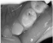 exposures with Complete caries removal Ribeiro, C.C., et al.