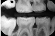 caries treatment) Fissure