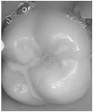 complete caries removal Fissure seal vs