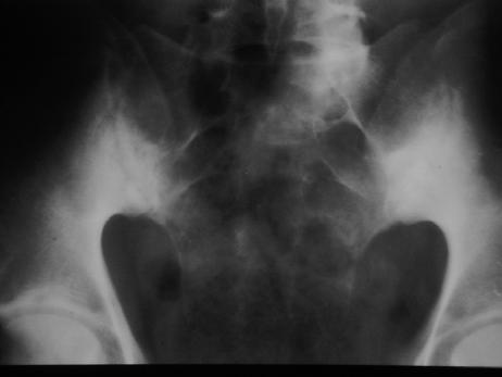 AS-Radiographic Manifestations AP pelvis sufficient
