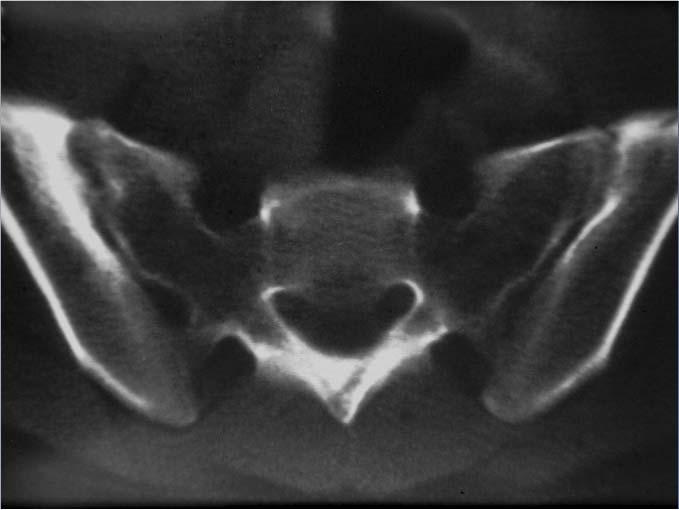 Sacroiliitis - CT Gold standard for erosions Radiation in