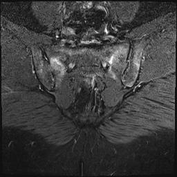 on T1 Active = BME or SC enhancement Single lesion on two or more slices Multiple lesions on single slice Capsulitis