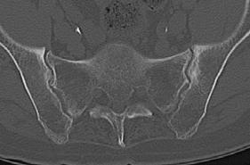 74M with OA MRI sacroiliac (SI) joints Osteitis