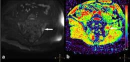 Sacroiliitis-MRI New Techniques Diffusion weighted imaging (DWI) Quantitative assessment of dz