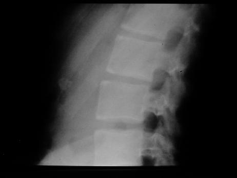 1007 /s00296-018-4130-1 AS-Radiographic Manifestations Spine Disease - ascends from lumbar to