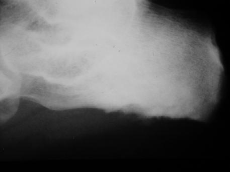 Enthesis Organ Tendon/ligament insertion Fibrocartilage Bursa Fat pad Cancellous bone Investing fascia Enthesitis Enthesitis triggers joint