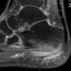 Enthesitis - MRI Thickening of tendon with T2 Insertional BME Not specific!