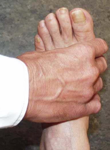General approach to inflammatory arthritis Match the test to the disease Rheumatoid Arthritis Ankylosing