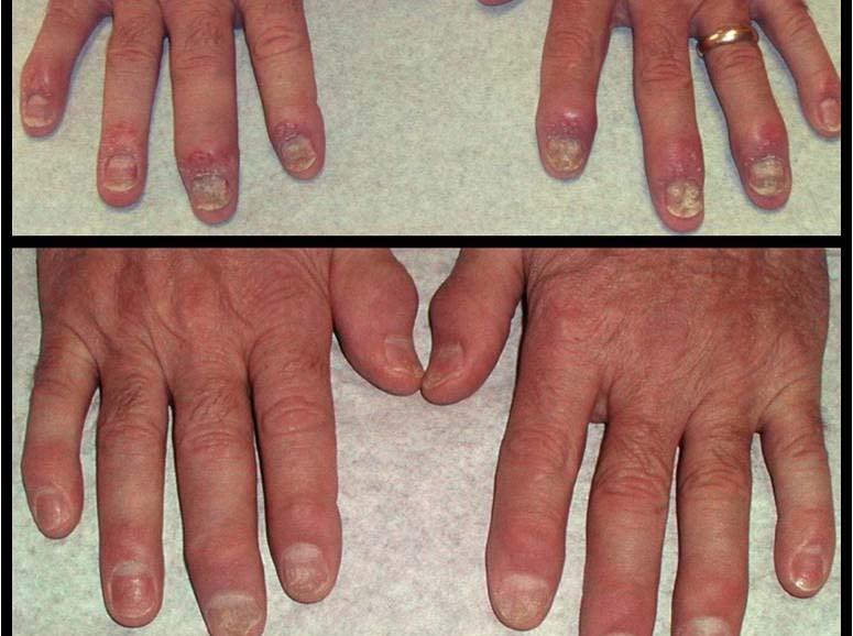 disease Rheumatoid Arthritis