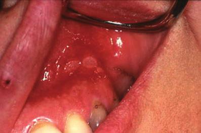 Recurrent oral ulceration and identification and elimination of these factors may be useful in management of the patient.
